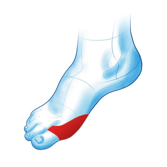 Prohaluks sil – osłona na haluks - obrazek 2